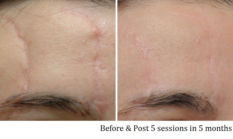 Scar removal before after 3