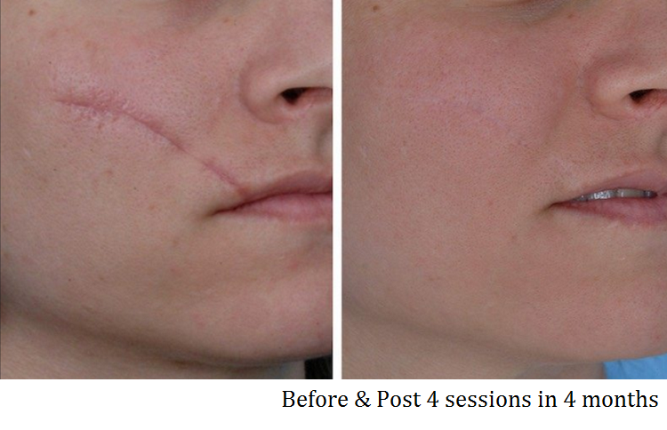 Scar Removal Before After 2