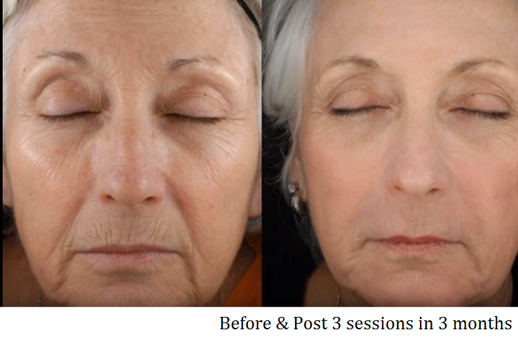 Skin Resurfacing before after 1